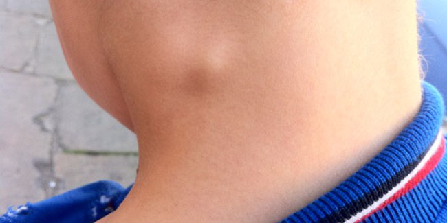 Лимфаденит У Детей Лечение Фото — Фото Картинки