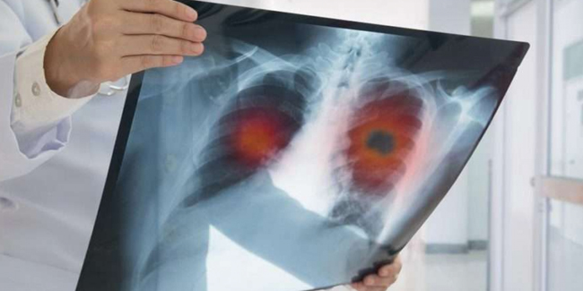 Erken teşhis akciğer kanserinde hayat kurtarıyor