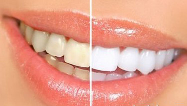 Dişlerde aranan beyazlığı yakalamak mümkün