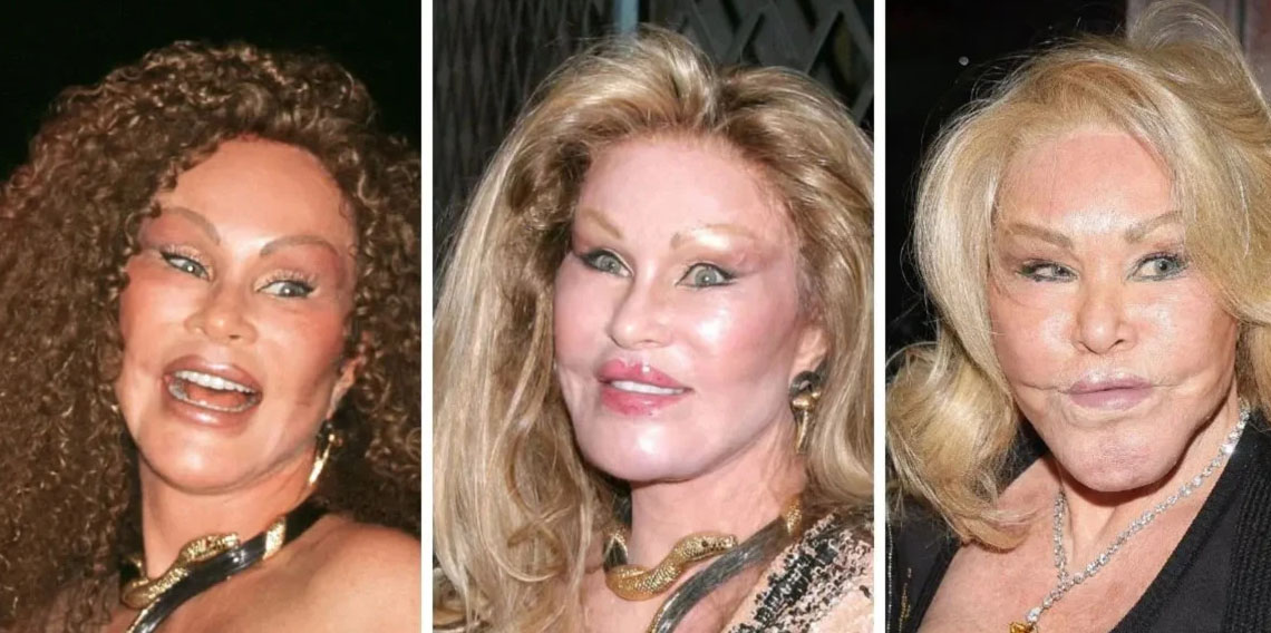 Kedi Kadın Jocelyn Wildenstein'den estetik açıklaması: 