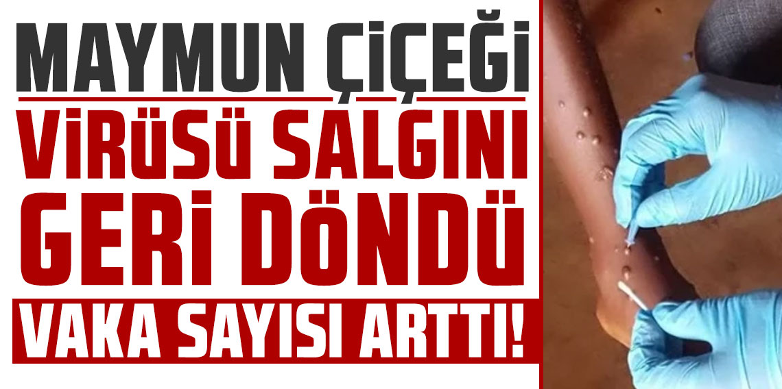 Maymun çiçeği virüsü salgını geri döndü: Vaka sayısı 300'ü aştı