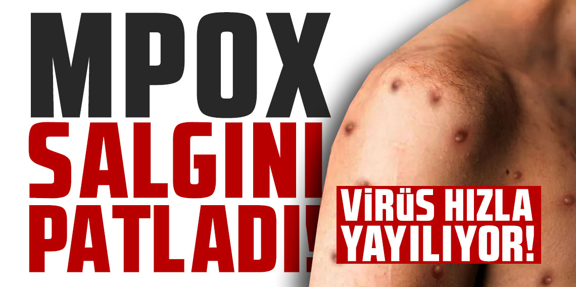 Mpox Salgını patladı: Sierra Leone'den rekor vaka!