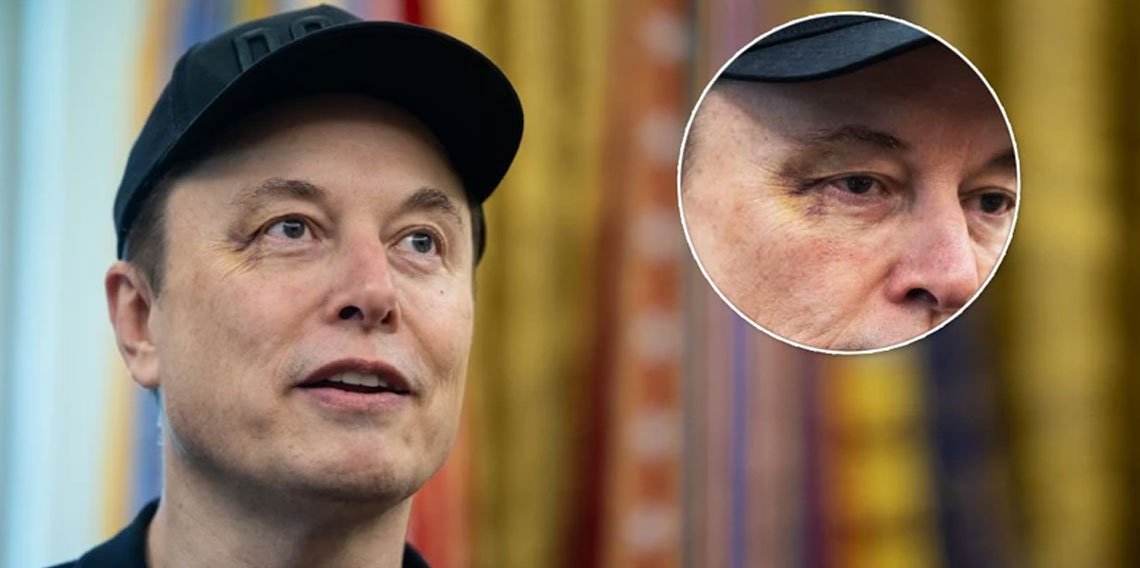 Elon Musk'ın yüzündeki morluğun sebebi belli oldu!