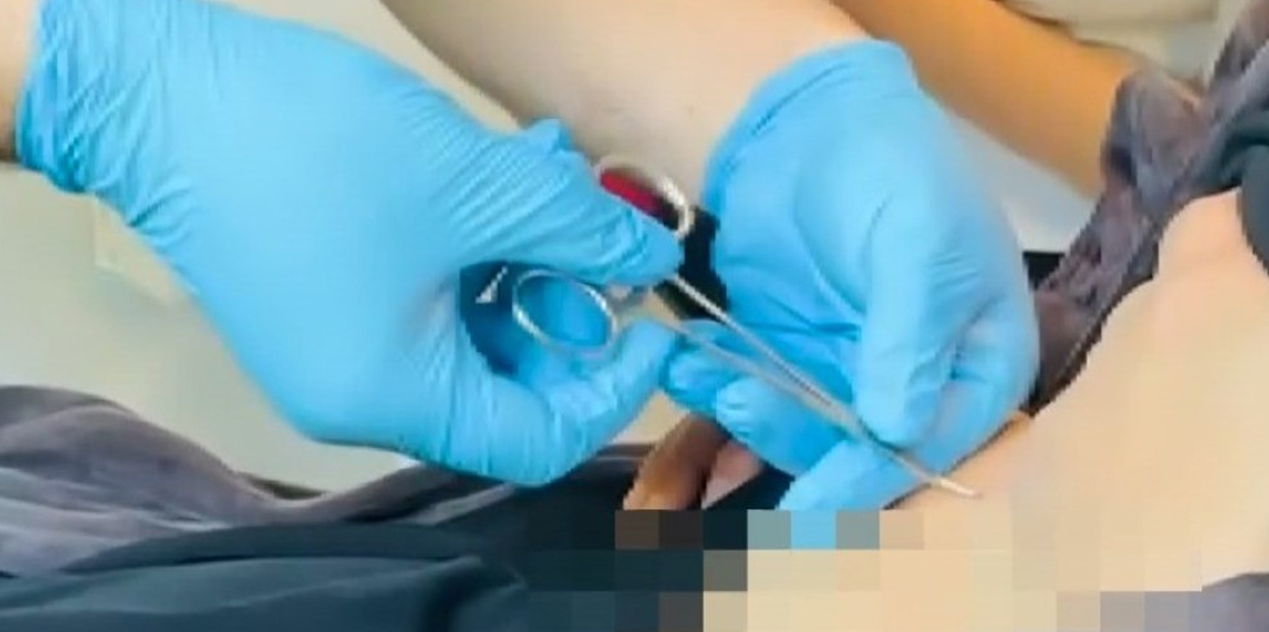 Hastaneye gitti, karnına yapışan kene ile karşılaştı