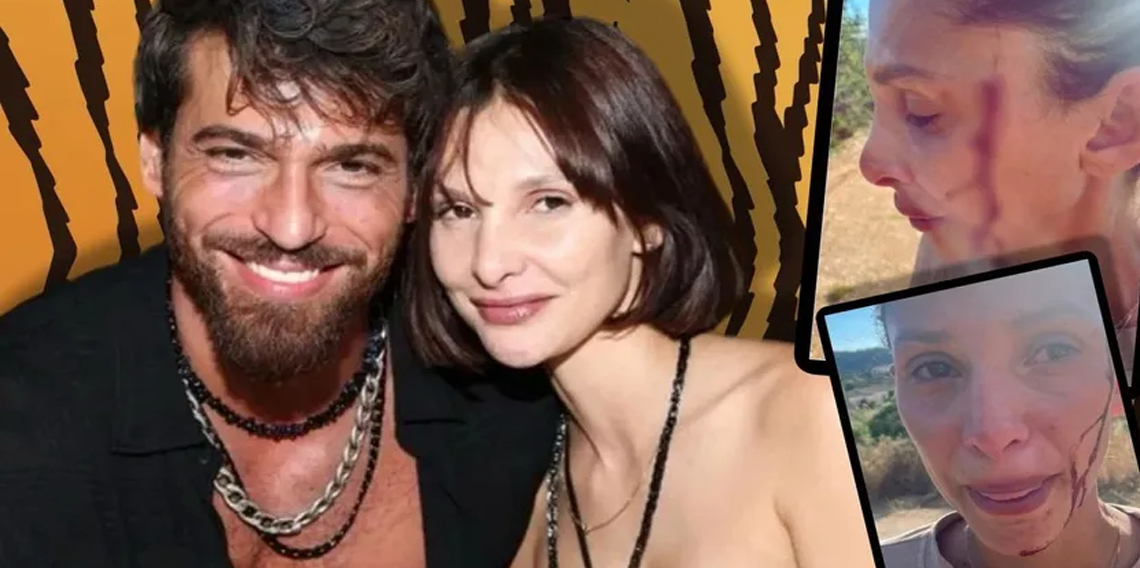 Can Yaman'ın sevgilisi, kanlar içinde paylaşım yaptı
