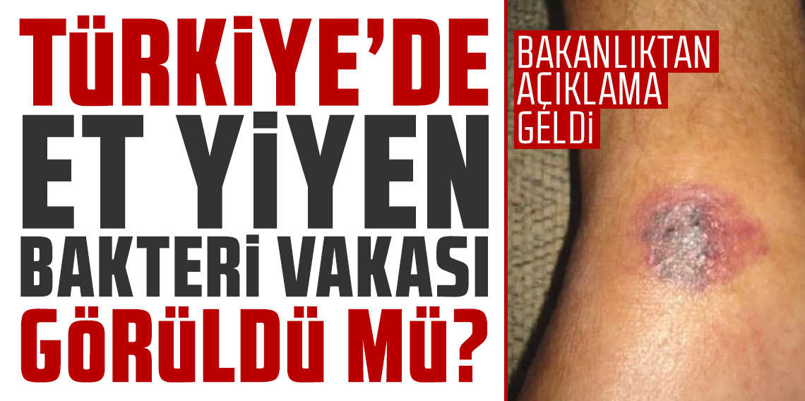 Türkiye'de et yiyen bakteri vakası görüldü mü? Bakanlıktan açıklama