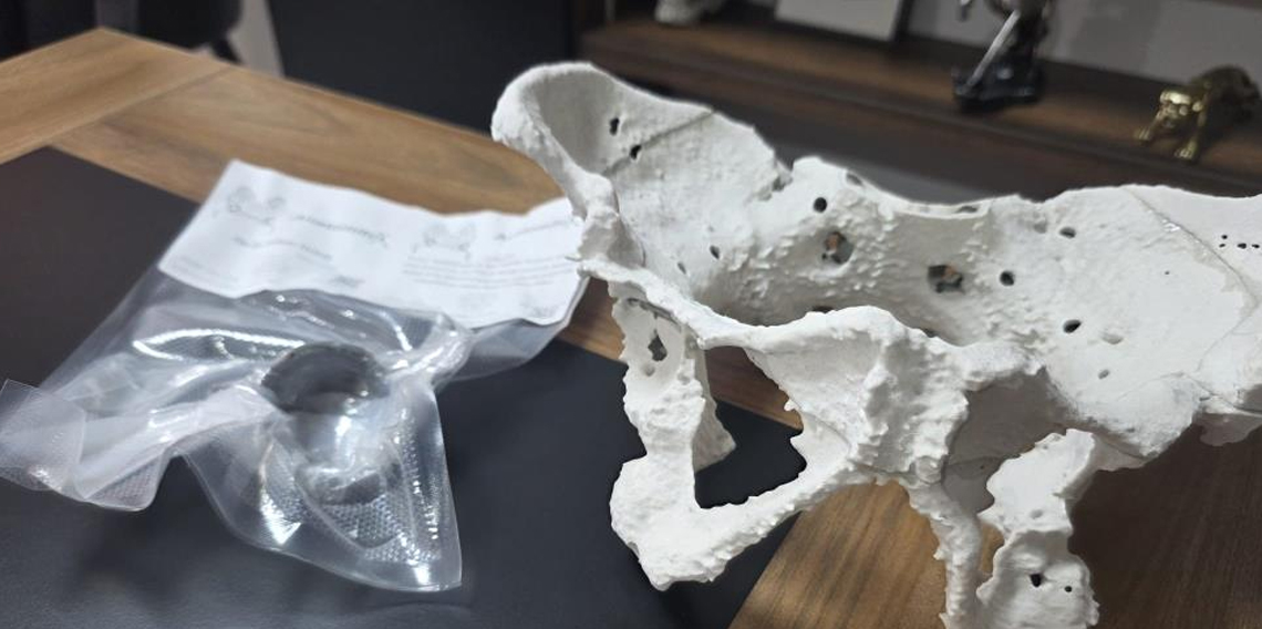 60 yaşındaki kadın 3D yazıcıyla üretilen kalça proteziyle sağlığına kavuştu