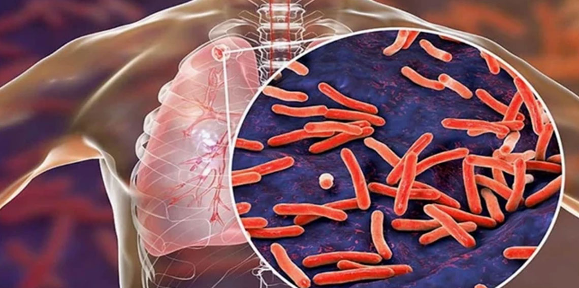 2024'te 1,2 milyondan fazla kişi tüberküloz nedeniyle öldü