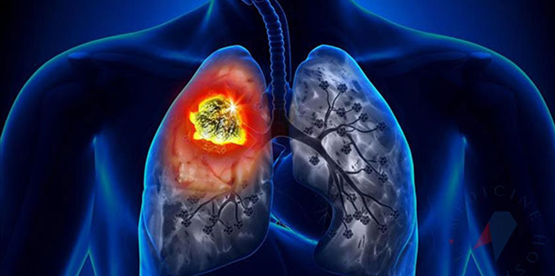 Uzmanlar uyarıyor erken teşhis hayat kurtarıyor