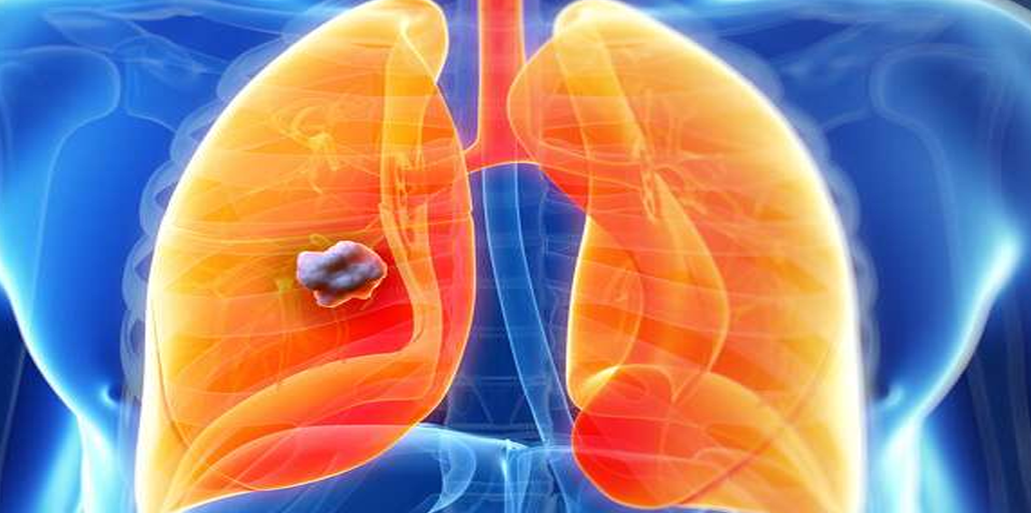 Akciğer nodülü kanser işareti olabilir