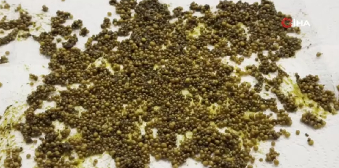 Hastadan çıkan taşları sayamadılar