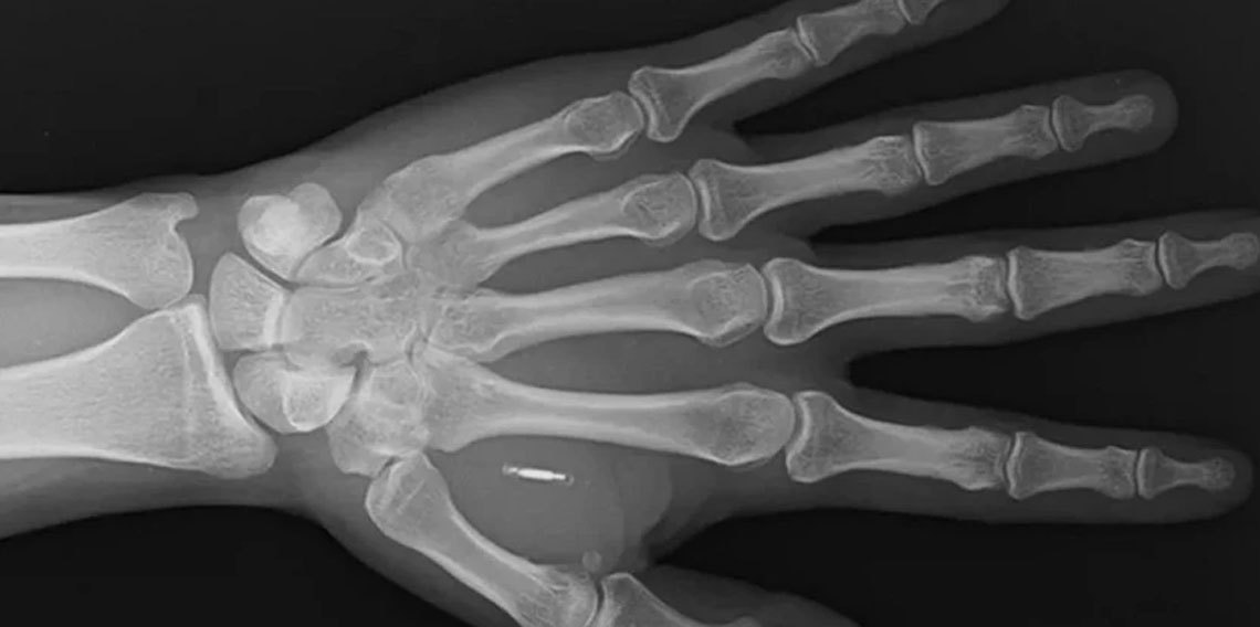 Vücuduna yerleştirdiği çipin şifresini unuttu