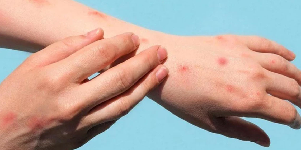 Maymun çiçeği virüsünün yeni bir varyantı tespit edildi