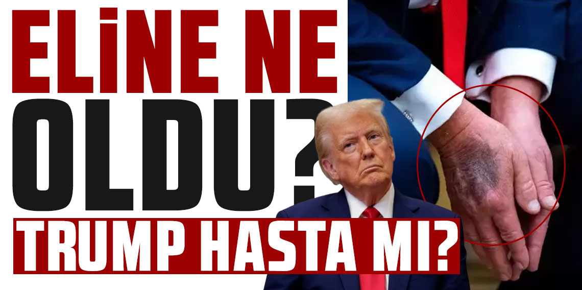 Trump hasta mı?  Elindeki morlukların nedenini ilk kez açıkladı!