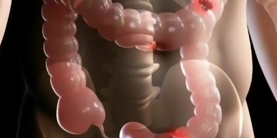 Kolon kanseri taramaları hayat kurtarıyor