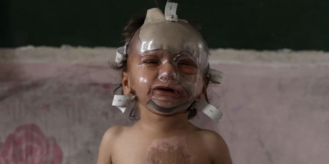 İsrail saldırılarında ağır yaralanan bebek tedavi bekliyor