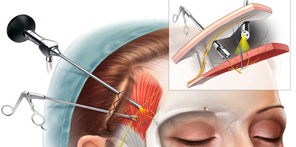 Doç. Dr. Koca’dan migren açıklaması