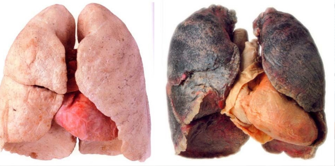 Uzman Uyardı: Sigara KOAH Riskini Katlıyor