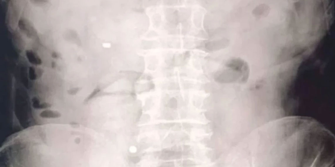 Midelerinden 1 kilo 70 gram metamfetamin çıktı!