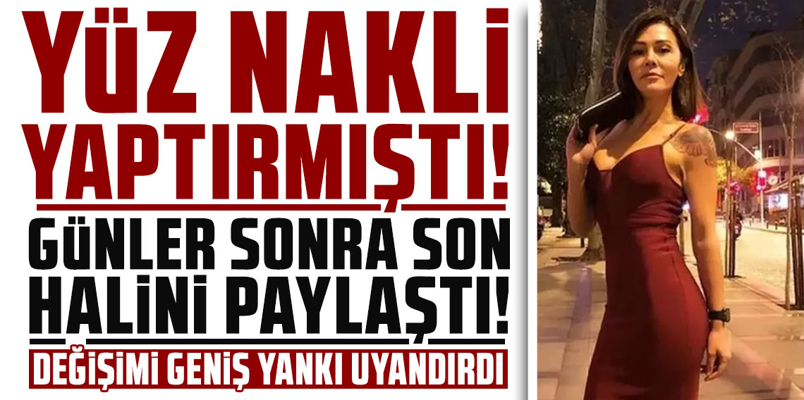 Yüz nakli yaptıran Didem Ceran, günler sonra son halini paylaştı