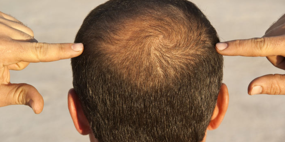 Kellik DNA’da mı Yazılı, Saç Dökülmesinin Perde Arkası