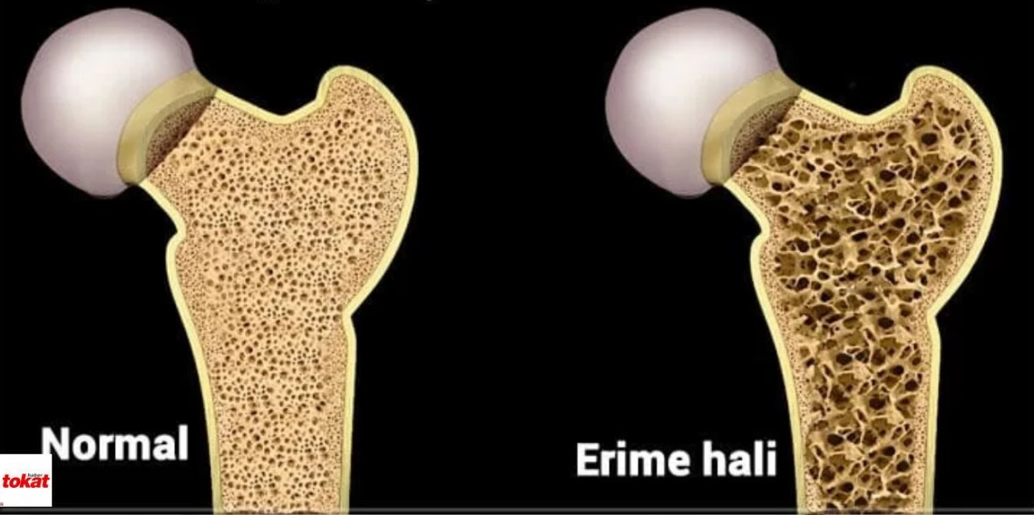 Zayıf ve Hareketsiz Yaşam Kemik Erimesi Riskini Artırıyor