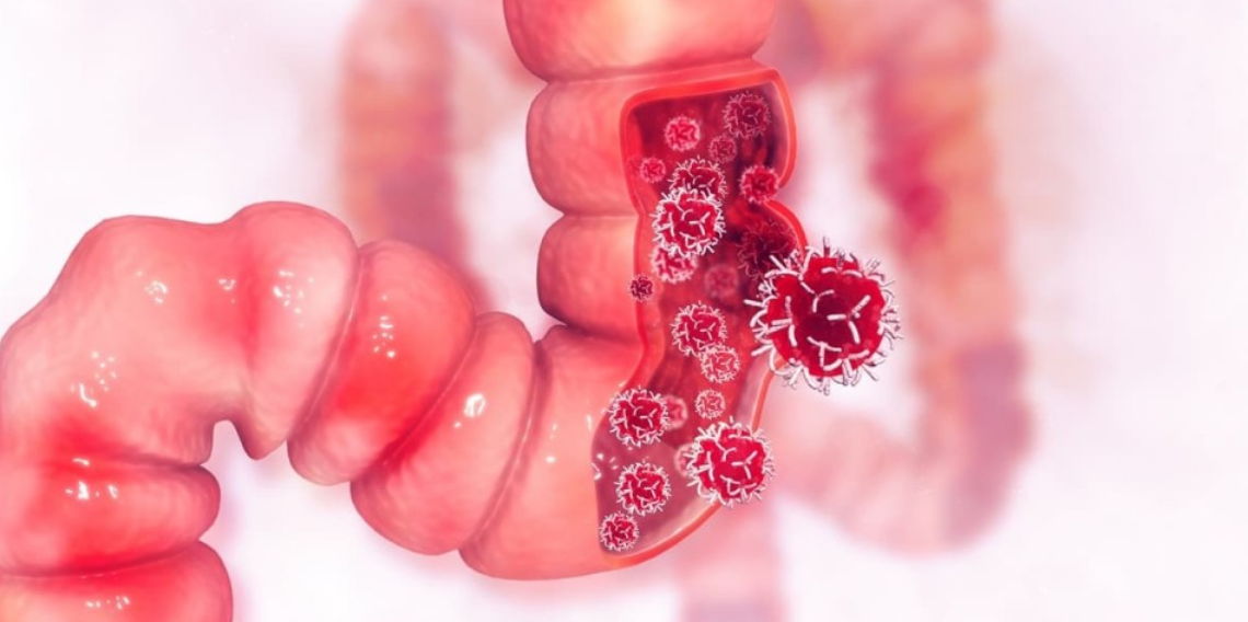 Kolon kanserinde erkeklerde risk daha fazla