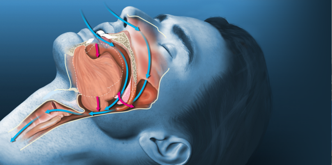 Uyku apnesi kalp krizi ve inme riskini artırıyor