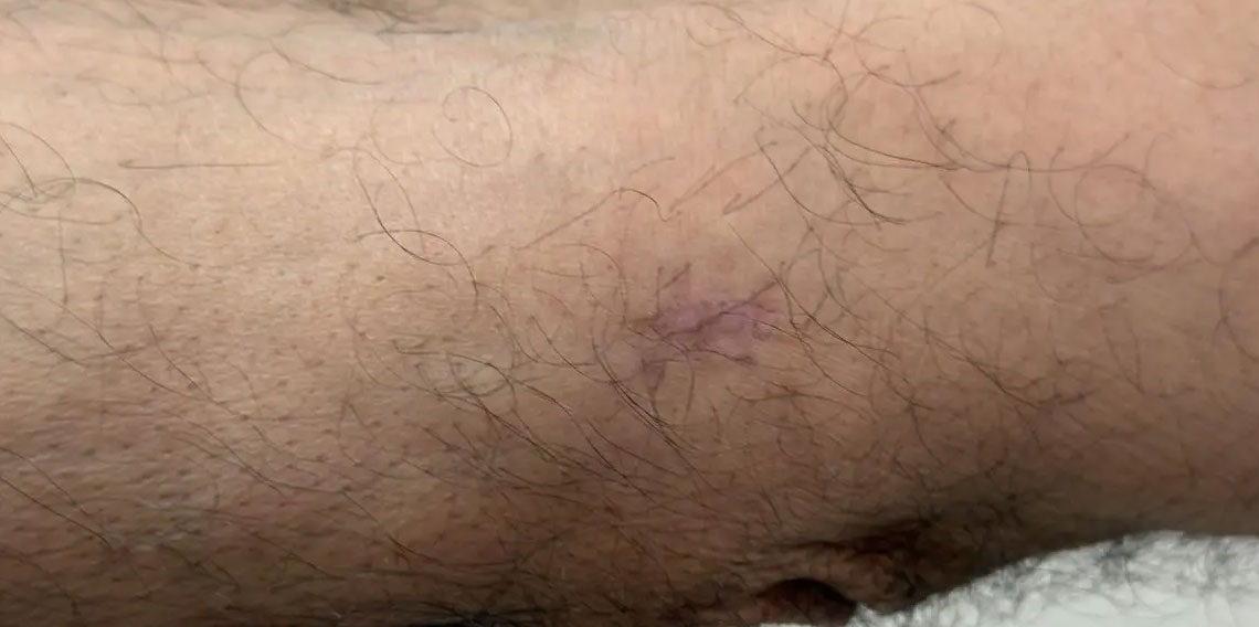 Kolundaki yara için gitti, kanser olduğunu öğrendi
