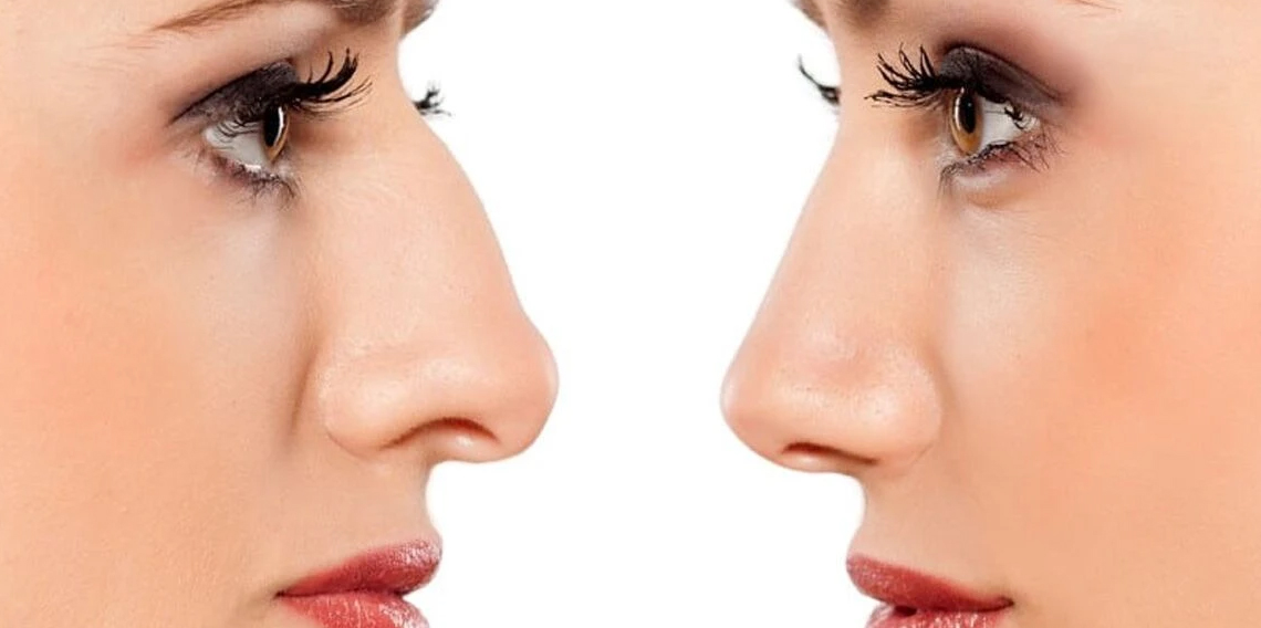 Uzmanından rinoplastide 'doğal görünüm' uyarısı