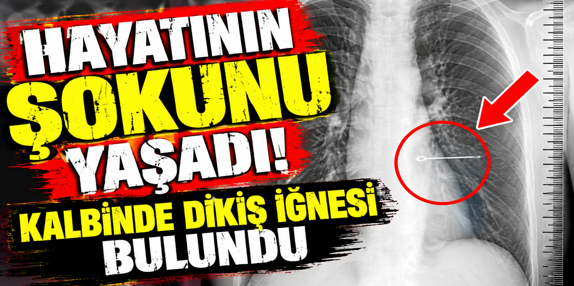 Hastanede hayatının şokunu yaşadı! Kalbinde dikiş iğnesi bulundu